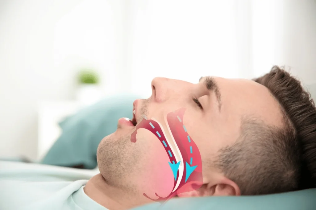 apnea notturna