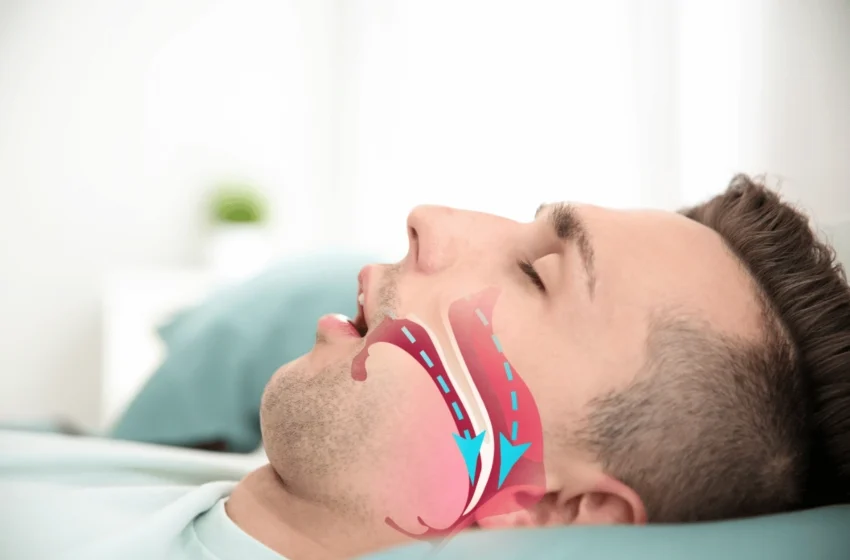 apnea notturna